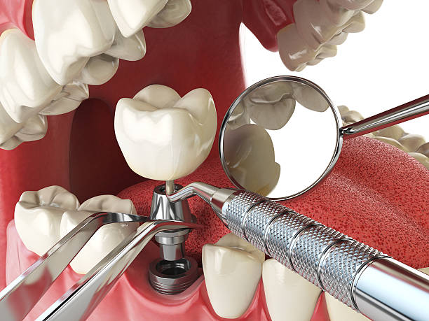 Best Knocked-Out Tooth (Avulsed Tooth) Treatment in Bradford, TN